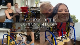 Agenesis of the Corpus Callosum  Physiotherapy Updates [upl. by Caz]