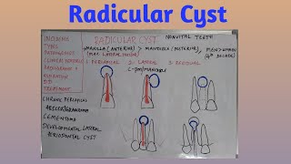 Radicular cyst [upl. by Emia]