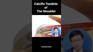 Understanding Calcific Tendinitis Stages Symptoms and Treatment Options 석회성 건염의 이해 단계 증상 및 치료 방법 [upl. by Budworth399]