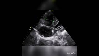 Ventricular septal defect [upl. by Merideth346]