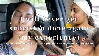 SUBCISION FOR PITTED ACNE SCARS MY EXPERIENCE I WILL NEVER DO IT AGAIN icepickrolling amp box scars [upl. by Adnat]