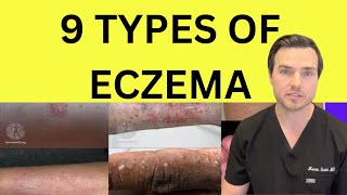 All 9 types of Eczema explained by Dr Martin Smith [upl. by Mari]