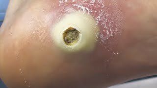 Big yellow hole on the feet  Much scary and horrible  pedicure treatment [upl. by Hadihahs695]