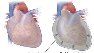 My Pericarditis or Heart Fluid Buildup I think it was caused by an infection It happened suddenly [upl. by Nolra775]