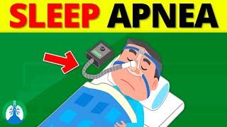 What is Sleep Apnea Obstructive vs Central Sleep Apnea [upl. by Sidney988]