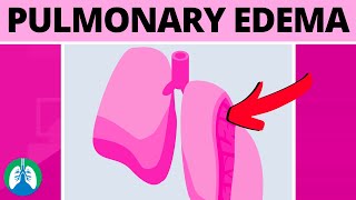 Pulmonary Edema Medical Definition  Quick Explainer Video [upl. by Anyek]