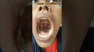 tonsillitis tonsils neetmotivation ent [upl. by Nnaarual]