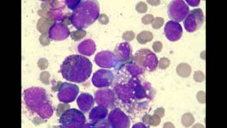 Acute Myelomonocytic Leukemia M4 EO 2 patients [upl. by Oal]