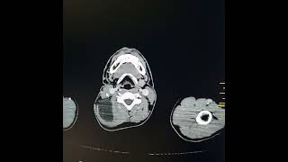 Lymphangioma along right side of neck and upper posterior thorax [upl. by Eednil]