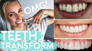 TEETH TRANSFORMATION  Porcelain Veneers  Before amp After  Review [upl. by Dahle749]