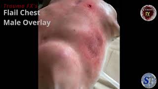 Trauma FX Flail Chest Video [upl. by Gabe845]