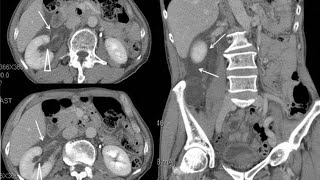 Moderate obstructive uropathy region due to renal calculus  cect abdomen and pelvis [upl. by Idak]