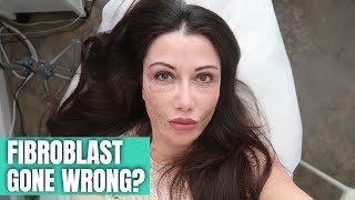 FIBROBLAST TREATMENT GONE WRONG [upl. by Annavas]