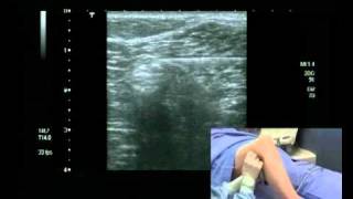 Popliteal Block Ultrasound guided  lateral approach [upl. by Guillema608]