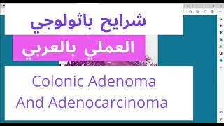 Colon histology  colonic adenocarcinoma  Tubulovillous adenoma low grade and high grade [upl. by Ari]