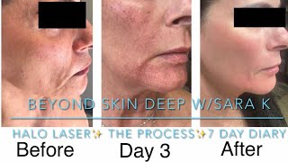 🌟HALO🌟 Resurfacing Laser treatment 🔥DEMO🔥 7 day DIARY Photos 📸 included…NOT paid [upl. by Panayiotis]