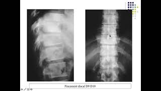 LA SPONDYLODISCITE TUBERCULEUSE ET NON TUBERCULEUSE [upl. by Mott768]