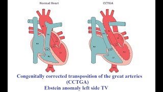 Congenitally corrected transposition of the great arteries CCTGA wth Ebstein anomaly left side TV [upl. by Enyawad]