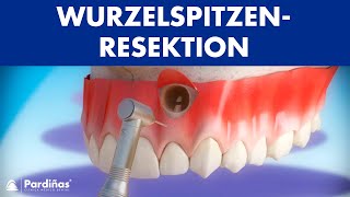 Wurzelspitzenresektion © [upl. by Aivonas]