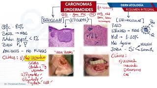 Dermatología  Carcinoma epidermoide [upl. by Submuloc]