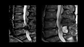 Presentation  A Neurological Perspective of Cauda Equina Syndrome [upl. by Aljan54]