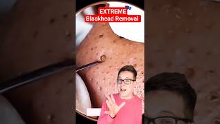 ⚠️ BIGGEST BLACKHEAD REMOVAL  Reaction shorts [upl. by Nylecsoj]