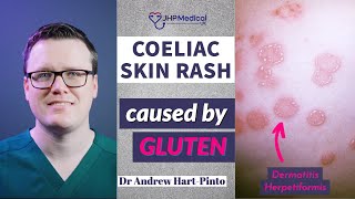 Dermatitis Herpetiformis Skin Rash Linked To Coeliac Disease Celiac And Gluten Intolerance [upl. by Fabrin754]