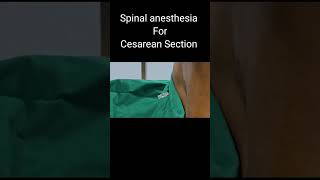 Spinal Anesthesia in Cesarean  OT stories  YouTubeShorts [upl. by Ketchan]