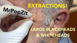 Awesome acne extractions Some solar comedones Favre some regular blackheads and whiteheads [upl. by Nylrad]