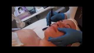 Eye and Lip Peel Demonstration Ritacca Laser amp Cosmetic Surgery Center [upl. by Daub]