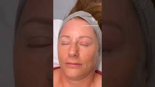 Plasma Pen  Subnovii Upper Eyelid Lift  Plasma Pen procedure  Blepharoplasty non surgical [upl. by Elliot215]