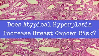 Does Atypical Hyperplasia Increase Breast Cancer Risk [upl. by Marchall]