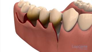 Periodontal flap approach surgery  Lapointe dental centres [upl. by Neit]