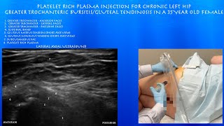 Ultrasound of Greater Trochanteric Bursitis Platelet Rich Plasma Injection in a 35 Year Old Female [upl. by Oiratnom]