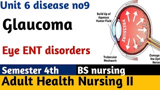 Glaucoma OpenAngle ClosedAngle Symptoms Pharmacology Pathophysiology Nursing lecture [upl. by Philip]