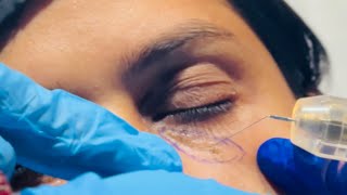 Is Bar Laser Xanthelasma Removal Karwa Liya  Cholesterol Deposit [upl. by Annairdna]