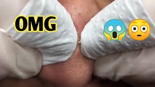 best white heads removal  closed comedones treatment  blackheads removal [upl. by Rap]