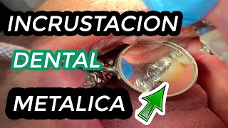 COMO se hacen las INCRUSTACIONES DENTALES METALICAS  Incrustación dental  Restauración de muela 🦷 [upl. by Pamela]