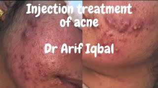 How to treat painful nodular acne  Steroid injection for acne  By DrArif Iqbal in delhi [upl. by Aronas]