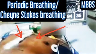 Periodic Breathing Cheyne Stokes Breathing mbbs medicine neetpg usmle next aiims neet [upl. by Hiram]