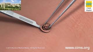 Skin Biopsy  CIMS Hospital [upl. by Ainnet]