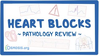 Heart blocks Pathology Review [upl. by Wilbert]