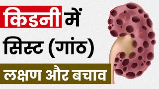 किडनी सिस्ट गांठ कारण लक्षण और उपचार  Kidney Cyst Causes Symptoms amp Treatment  Renal Cyst [upl. by Scever]