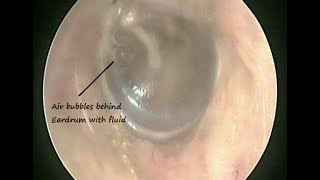 Otoendoscopy  Fluid behind Eardrum  Serous Otitis media  Glue ear  due to cold amp allergy [upl. by Imerej]