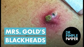 Mrs Golds Back Blackhead Extraction Session  Addressing the Inflamed One [upl. by Oruhtra]