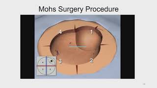 Mohs Micrographic Technique  An Overview [upl. by Selda]