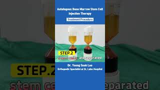 Autologous Bone Marrow Stem Cell Injection Therapy Treatment Procedure shorts [upl. by Anwat497]