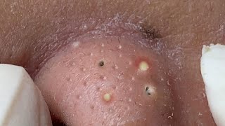 Big Cystic Acne Blackheads Extraction Blackheads amp Milia Whiteheads Removal Pimple Popping  3709 [upl. by Niamreg107]