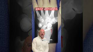 Wrist Arthritis Pain Fusion Relief shorts [upl. by Anitsim]