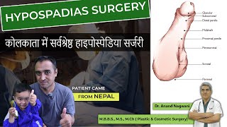 Best HYPOSPADIAS Surgery in Kolkata  Patient Came from Nepal  Best Age for Hypospadias Surgery [upl. by Lubet]